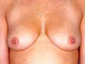 Patient # 29521 Before Photo # 1